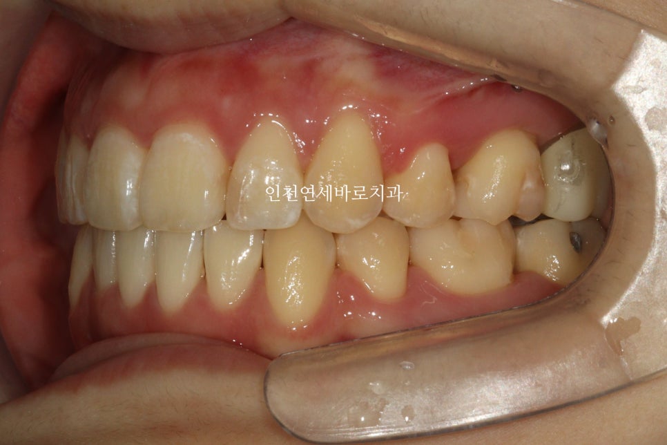 인비절라인 돌출입 발치교정치료