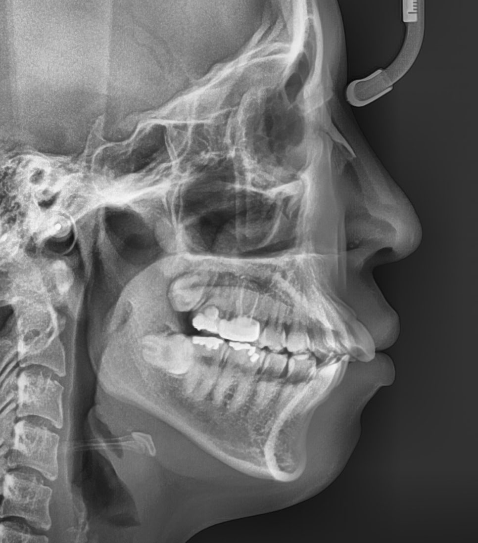 인비절라인 돌출입 발치교정치료