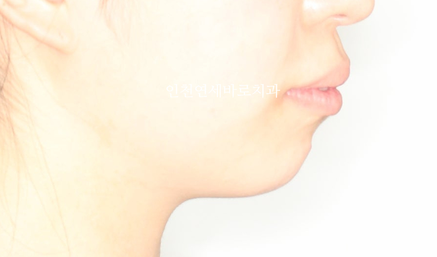 인비절라인 돌출입 발치교정치료