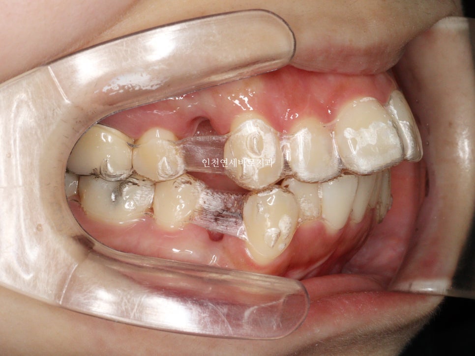 인비절라인 돌출입 발치교정치료
