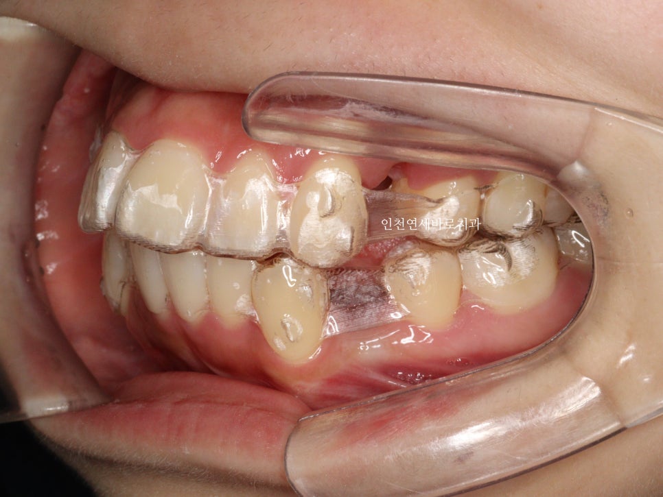 인비절라인 돌출입 발치교정치료