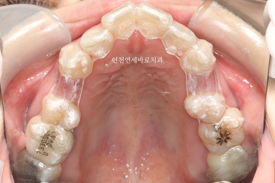 인비절라인 돌출입 발치교정치료