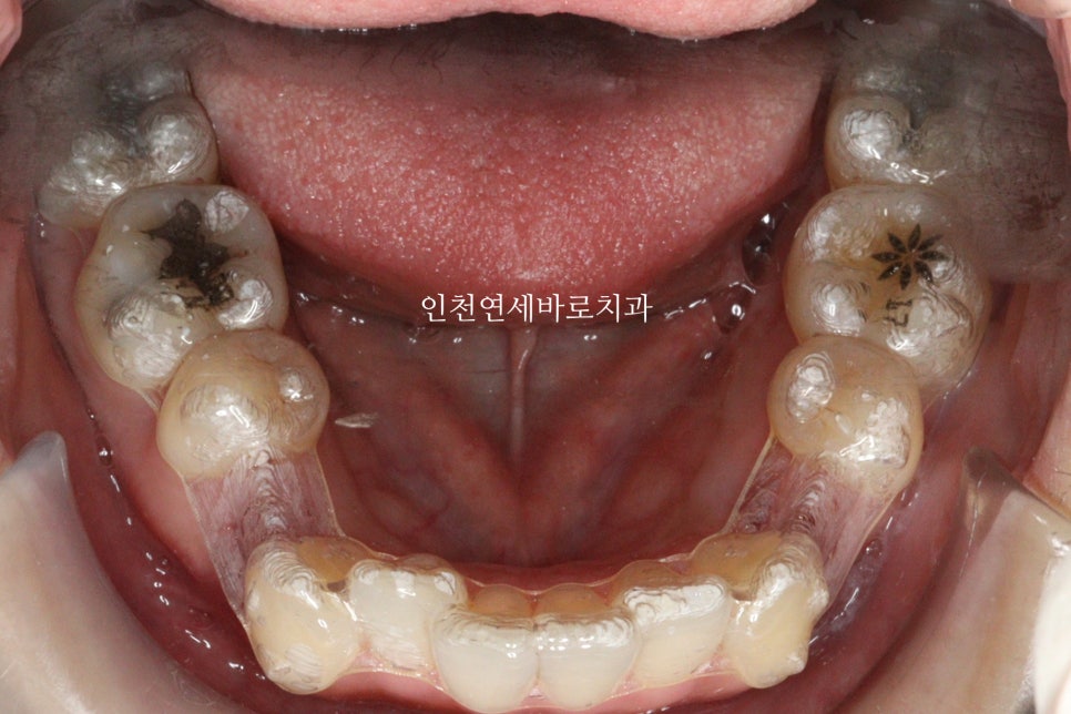 인비절라인 돌출입 발치교정치료