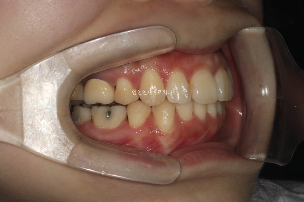 인비절라인 돌출입 발치교정치료
