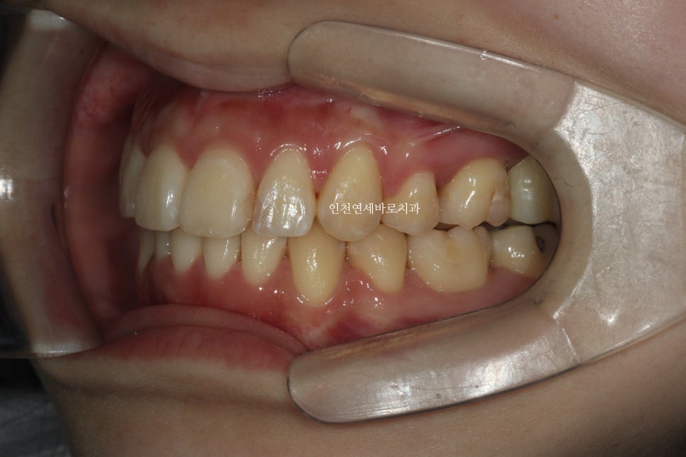 인비절라인 돌출입 발치교정치료