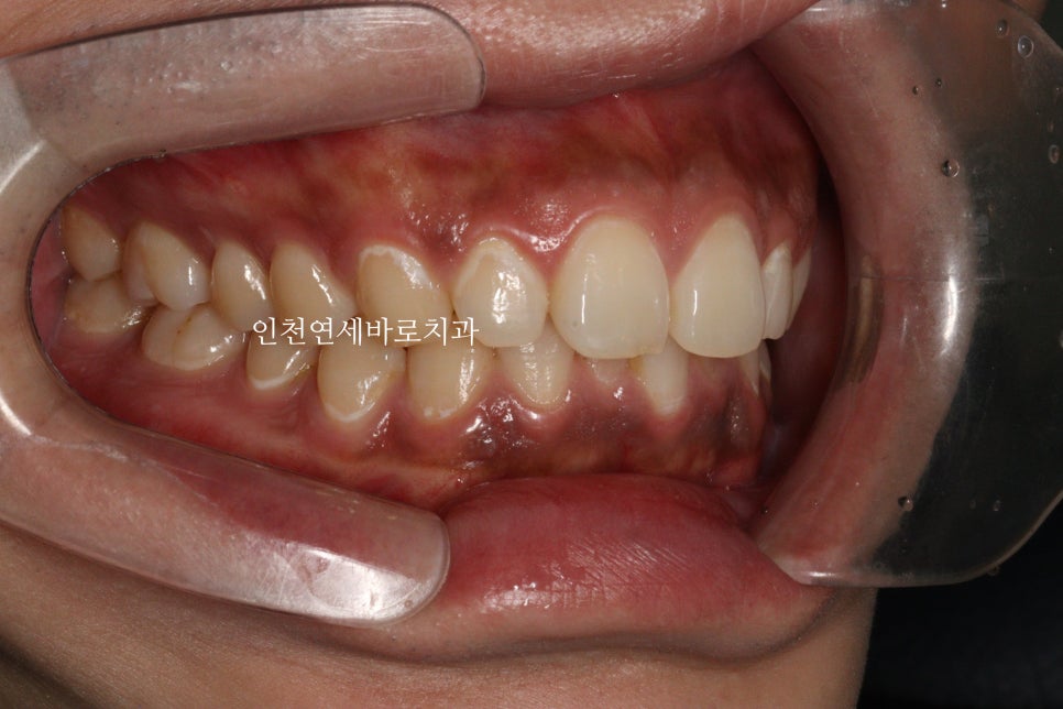 과개교합 투명교정치료 인비절라인 과개교합 치료 후기, 재제작 안함