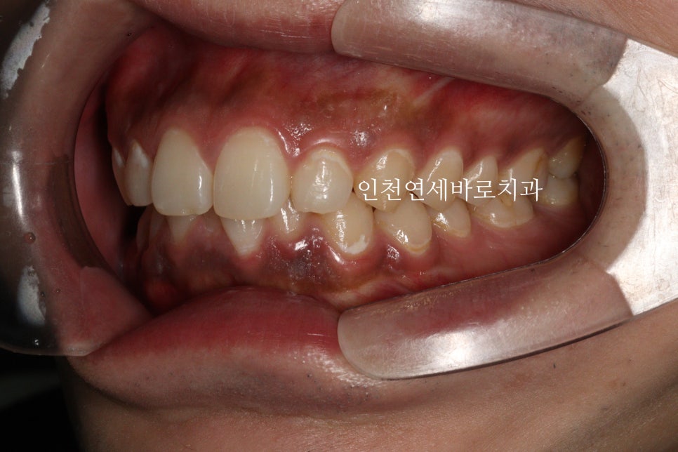 과개교합 투명교정치료 인비절라인 과개교합 치료 후기, 재제작 안함