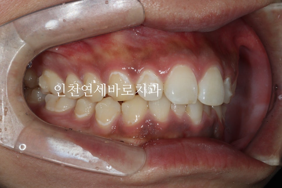 과개교합 투명교정치료 인비절라인 과개교합 치료 후기, 재제작 안함