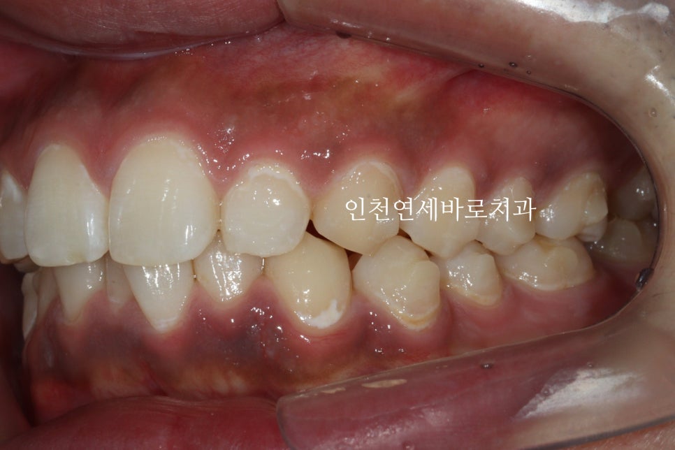 과개교합 투명교정치료 인비절라인 과개교합 치료 후기, 재제작 안함