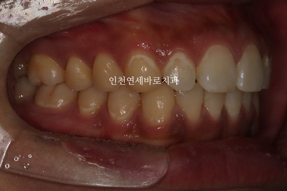 과개교합 투명교정치료 인비절라인 과개교합 치료 후기, 재제작 안함