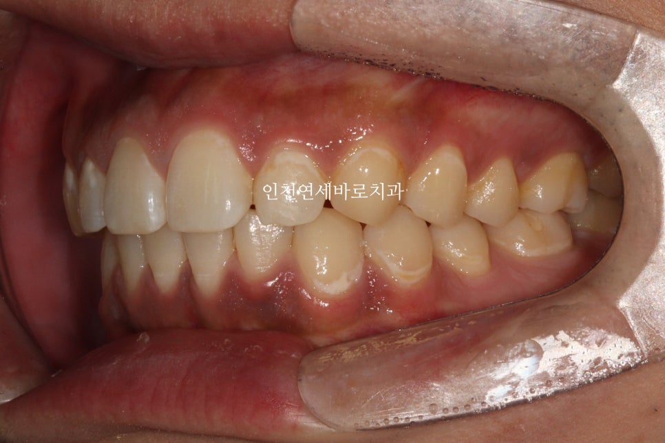 과개교합 투명교정치료 인비절라인 과개교합 치료 후기, 재제작 안함