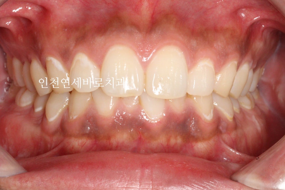 과개교합 투명교정치료 인비절라인 과개교합 치료 후기, 재제작 안함