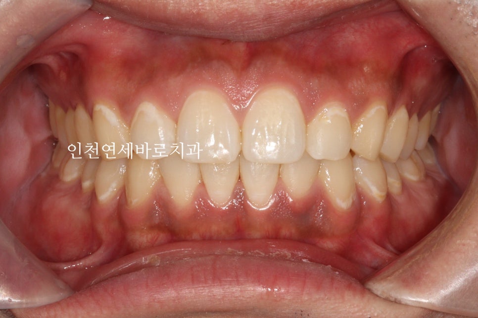 과개교합 투명교정치료 인비절라인 과개교합 치료 후기, 재제작 안함