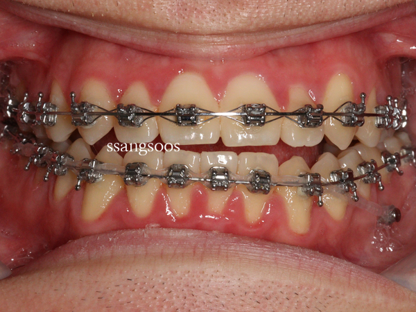 인비절라인 과 철사교정 사이에서 고민하는 분들께