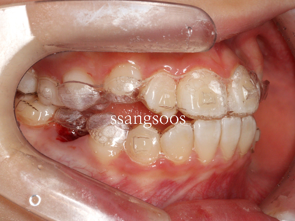 인비절라인 과 철사교정 사이에서 고민하는 분들께