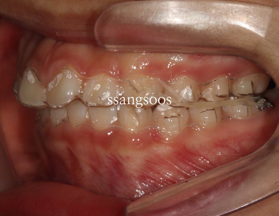 인비절라인 과 철사교정 사이에서 고민하는 분들께