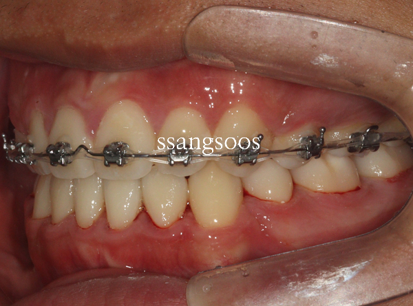 인비절라인 과 철사교정 사이에서 고민하는 분들께