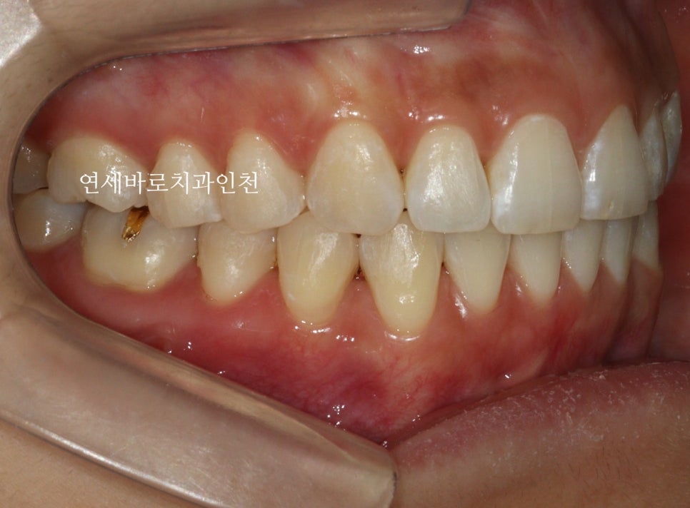 인비절라인 무턱교정 치료 후기 기록