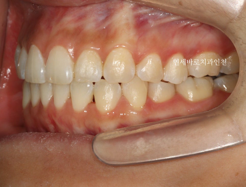 인비절라인 무턱교정 치료 후기 기록