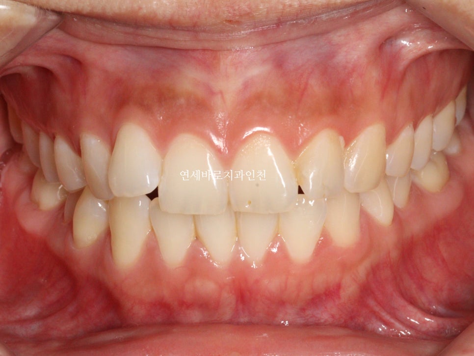 인비절라인 무턱교정 치료 후기 기록