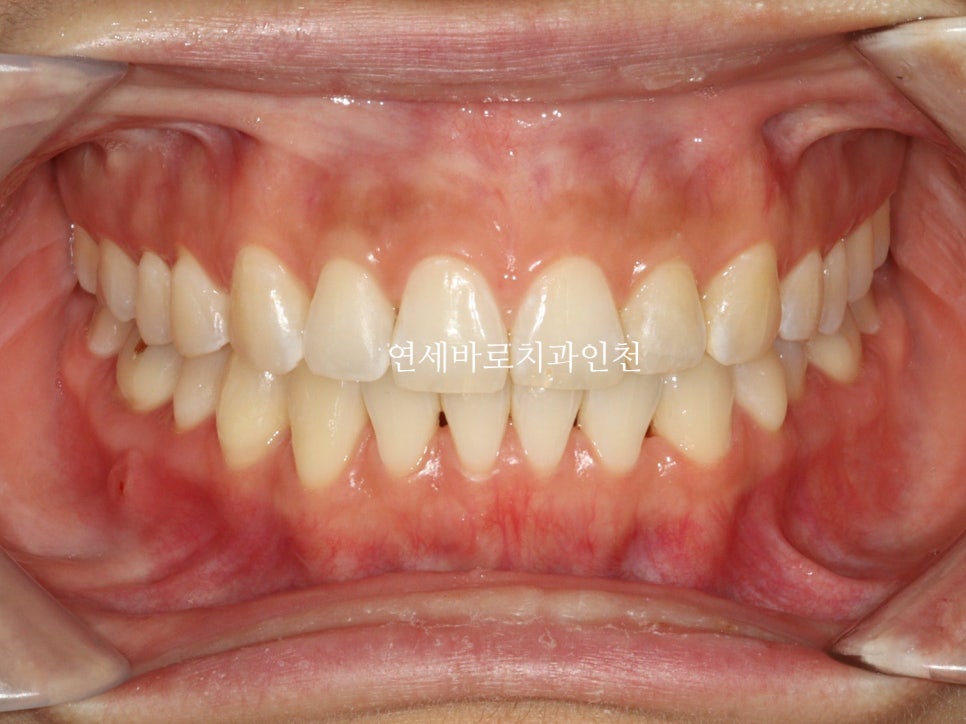 인비절라인 무턱교정 치료 후기 기록