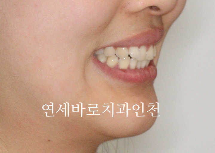 인비절라인 무턱교정 치료 후기 기록