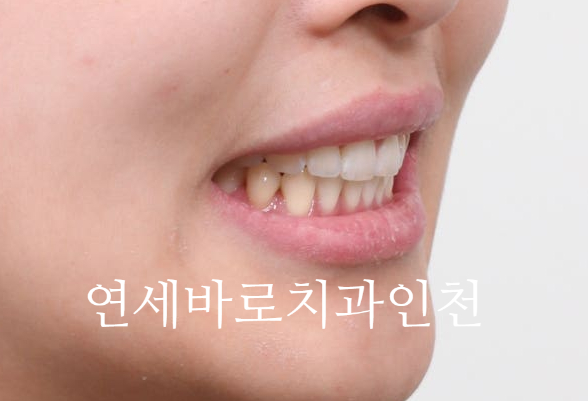 인비절라인 무턱교정 치료 후기 기록