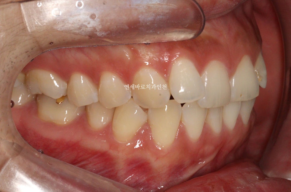 인비절라인 무턱교정 치료 후기 기록