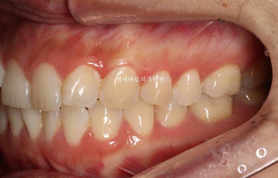 인비절라인 무턱교정 치료 후기 기록