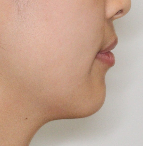 인비절라인 무턱교정 치료 후기 기록