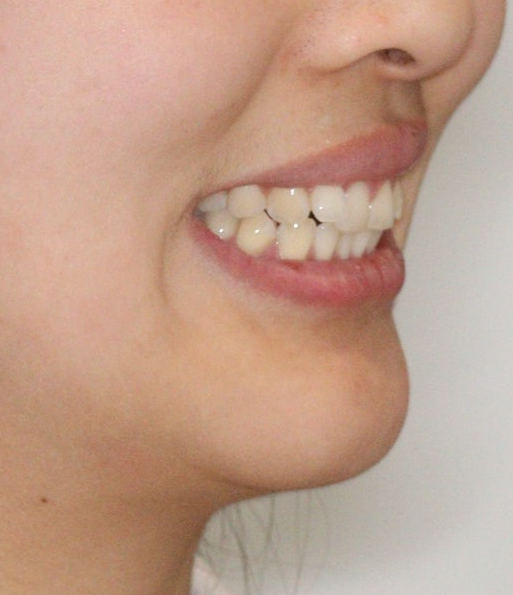 인비절라인 무턱교정 치료 후기 기록