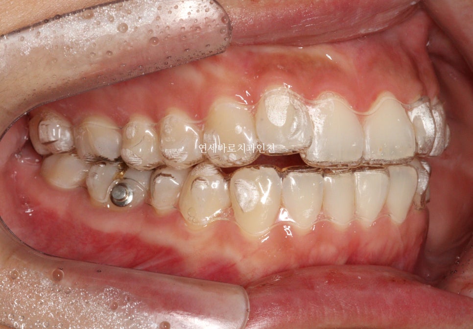 인비절라인 무턱교정 치료 후기 기록