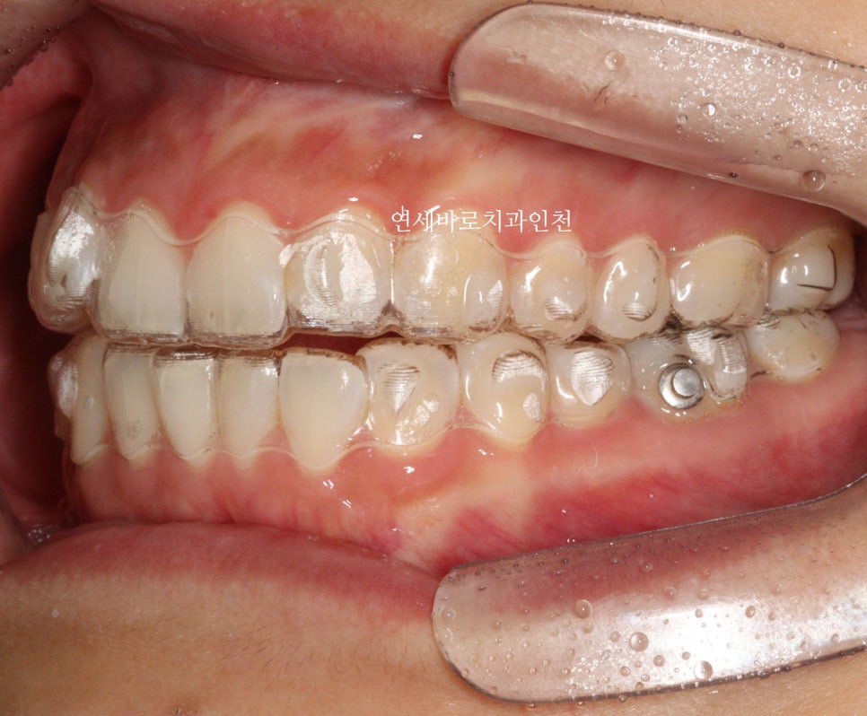 인비절라인 무턱교정 치료 후기 기록