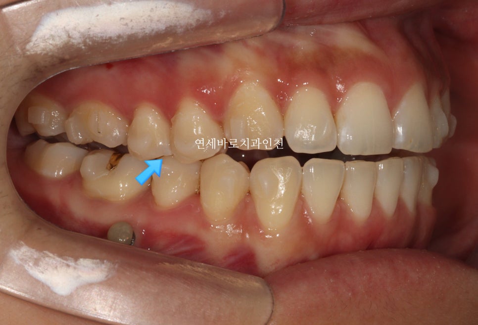 인비절라인 무턱교정 치료 후기 기록