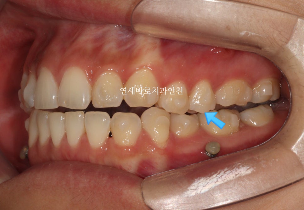 인비절라인 무턱교정 치료 후기 기록