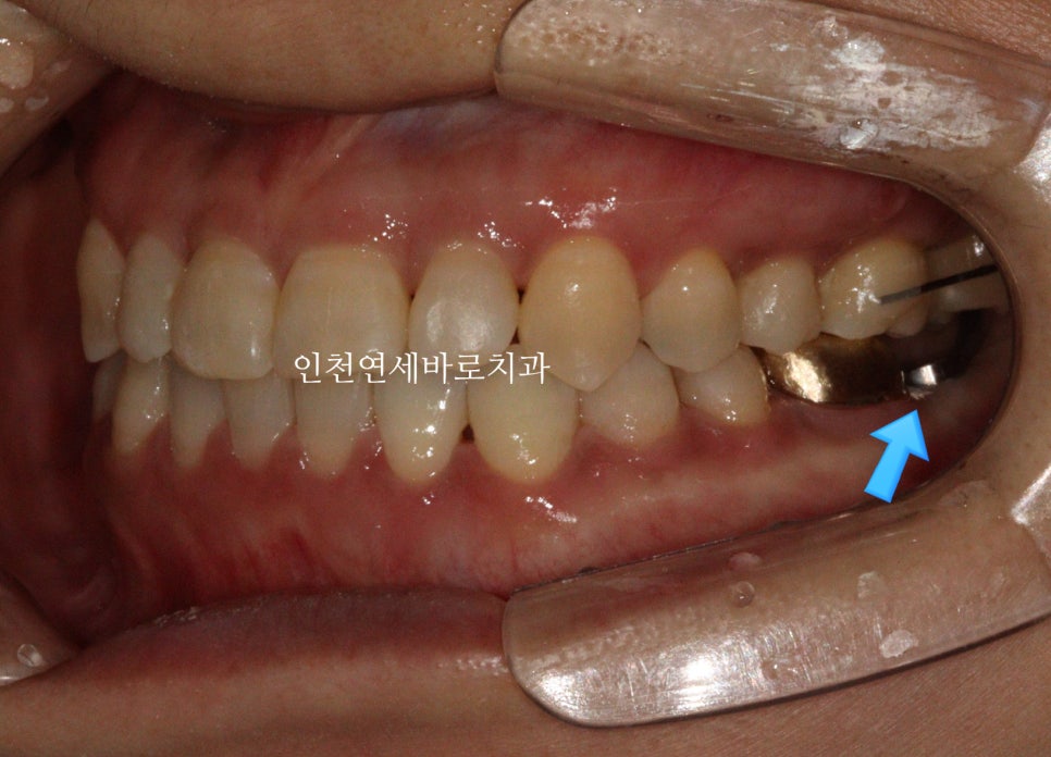 비수술 주걱턱 교정, 비발치 철사교정 치료 후기