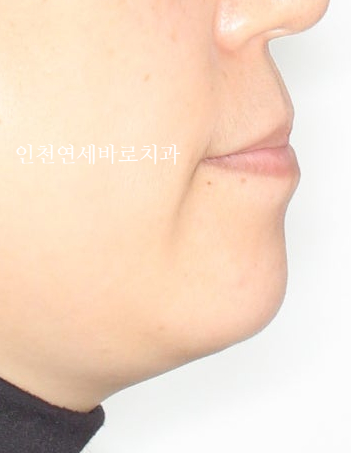 비수술 주걱턱 교정, 비발치 철사교정 치료 후기