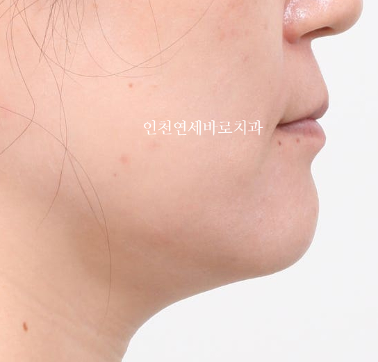 비수술 주걱턱 교정, 비발치 철사교정 치료 후기