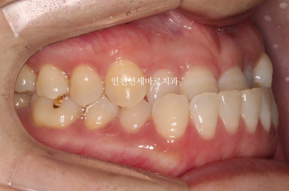 비수술 주걱턱 교정, 비발치 철사교정 치료 후기