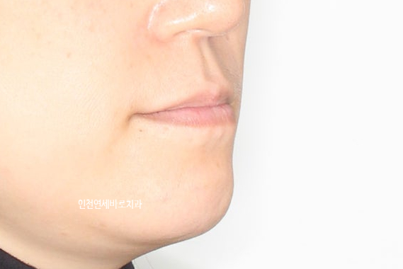 비수술 주걱턱 교정, 비발치 철사교정 치료 후기