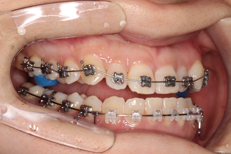 비수술 주걱턱 교정, 비발치 철사교정 치료 후기