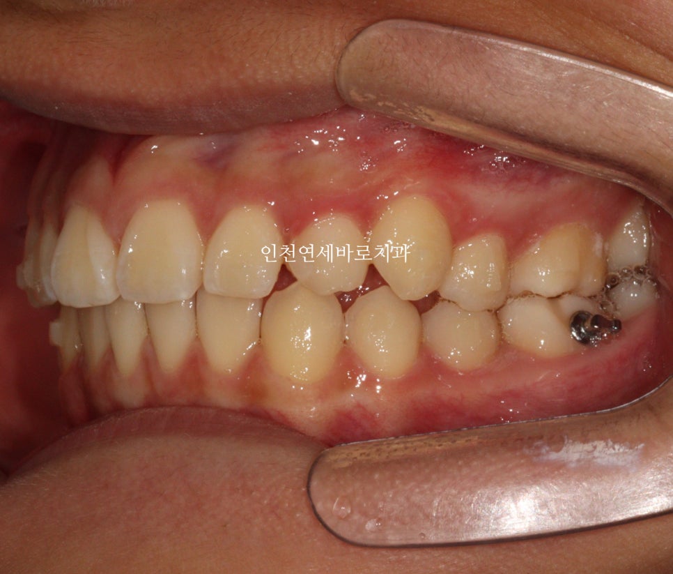 인비절라인 치료 치아 위치 이상 23년 11월~ 24년 10월 기록
