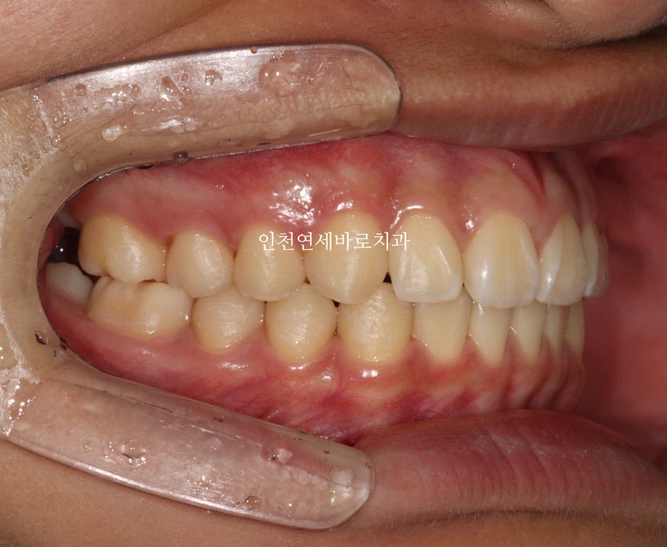 인비절라인 치료 치아 위치 이상 23년 11월~ 24년 10월 기록