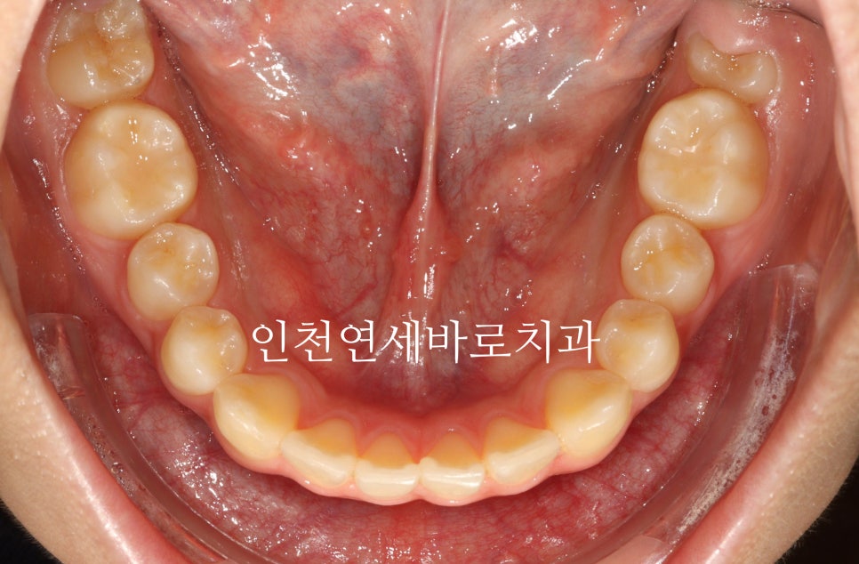인비절라인 치료 치아 위치 이상 23년 11월~ 24년 10월 기록
