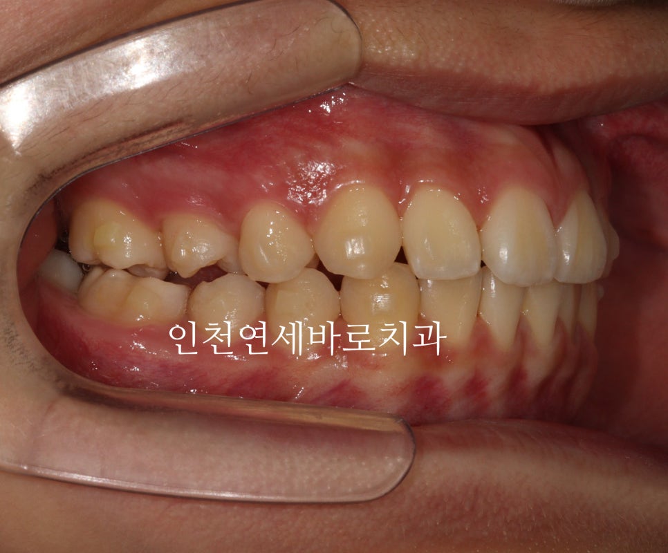인비절라인 치료 치아 위치 이상 23년 11월~ 24년 10월 기록