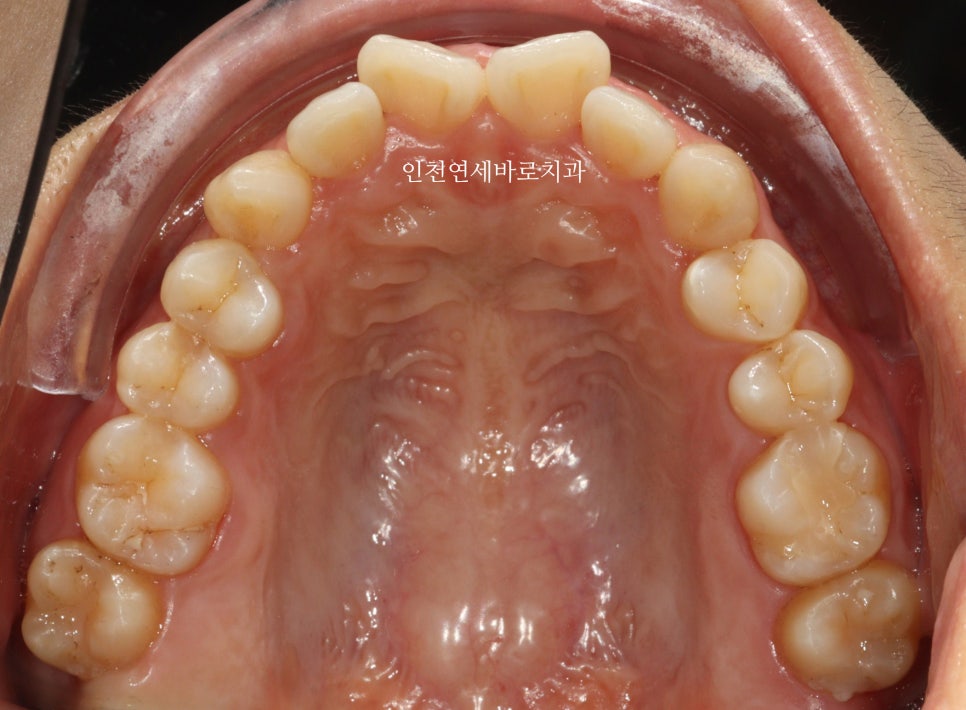 인비절라인 라이트 투명교정. 24년에 시작~24년에 끝