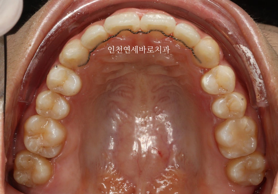 인비절라인 라이트 투명교정. 24년에 시작~24년에 끝