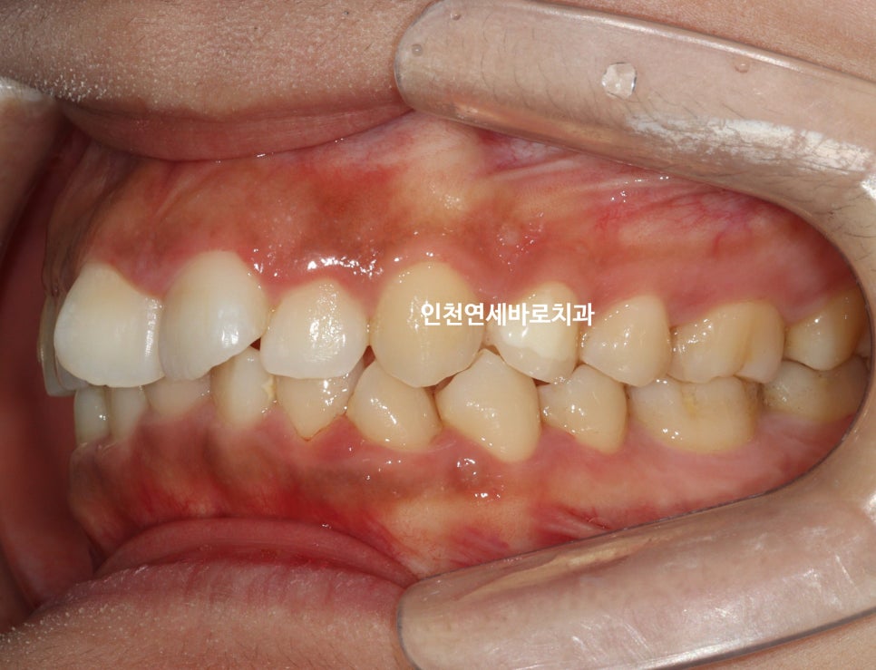 인비절라인 라이트 투명교정. 24년에 시작~24년에 끝