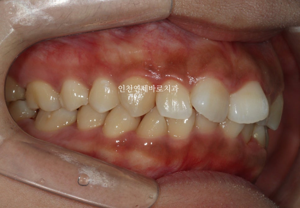 인비절라인 라이트 투명교정. 24년에 시작~24년에 끝
