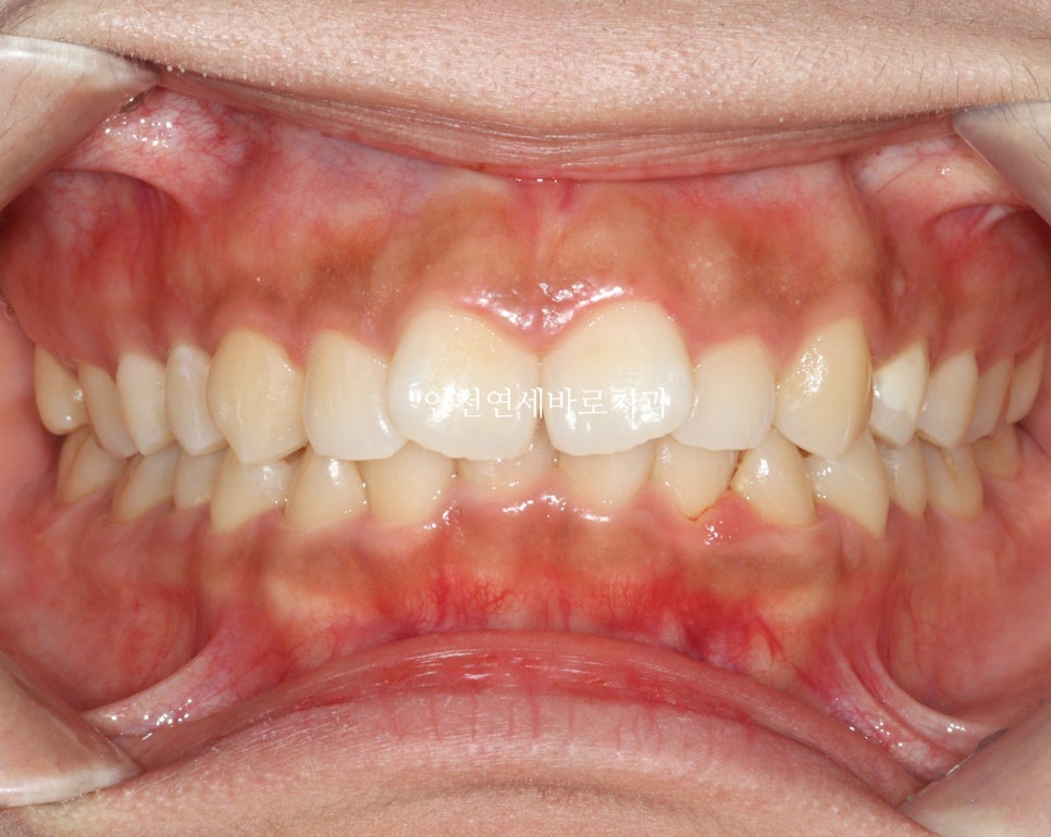 인비절라인 라이트 투명교정. 24년에 시작~24년에 끝